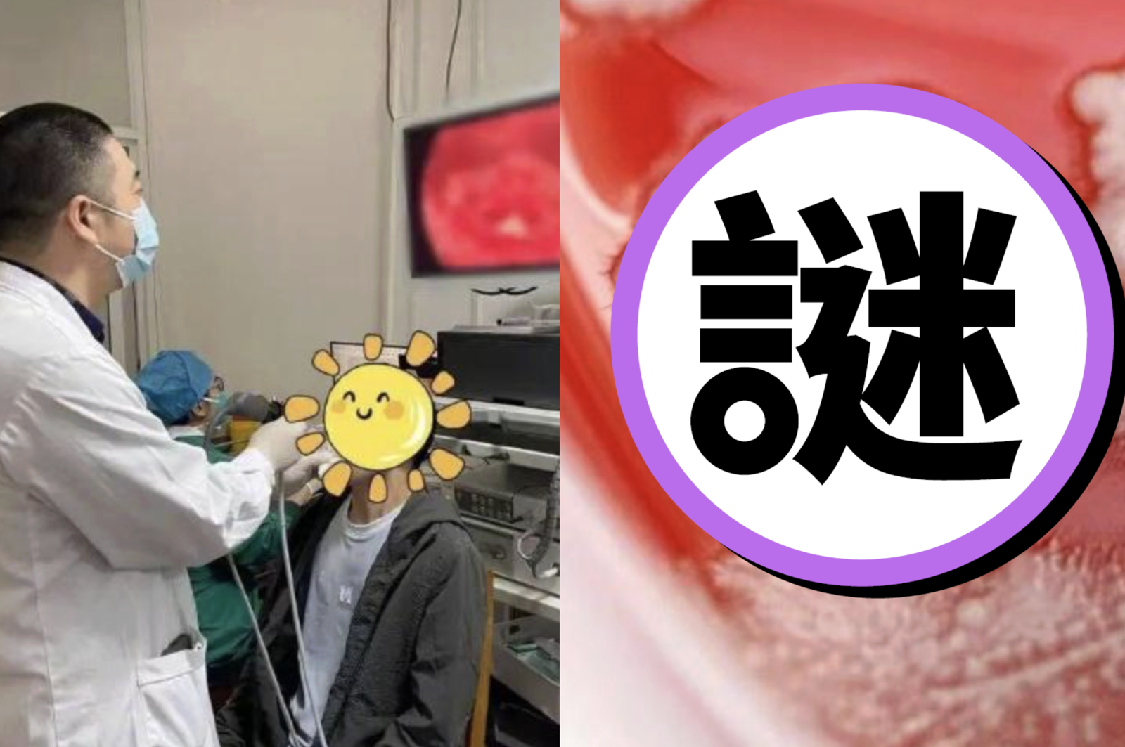 以為能消炎！36歲男感冒狂吞抗生素　喉嚨「長出一排雪花」慘罹1疾病