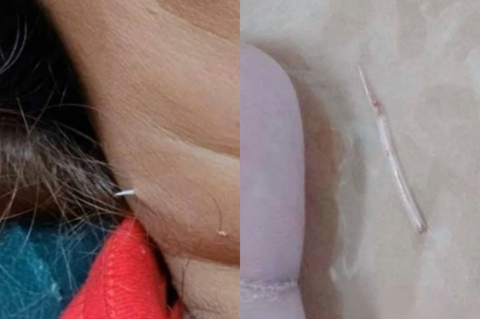 吞下魚刺找不到！2週後「刺穿脖子」驚悚畫面曝　婦嚇壞：不敢吃魚了