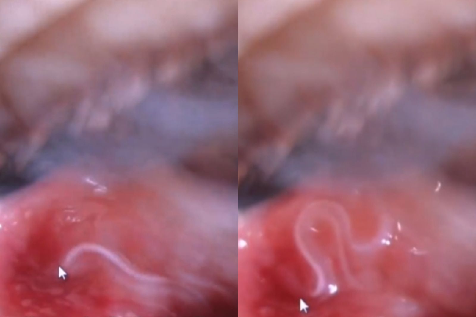 眼睛突發癢、發紅!女照鏡子「拔出3條寄生蟲」 瘋狂蠕動畫面曝光