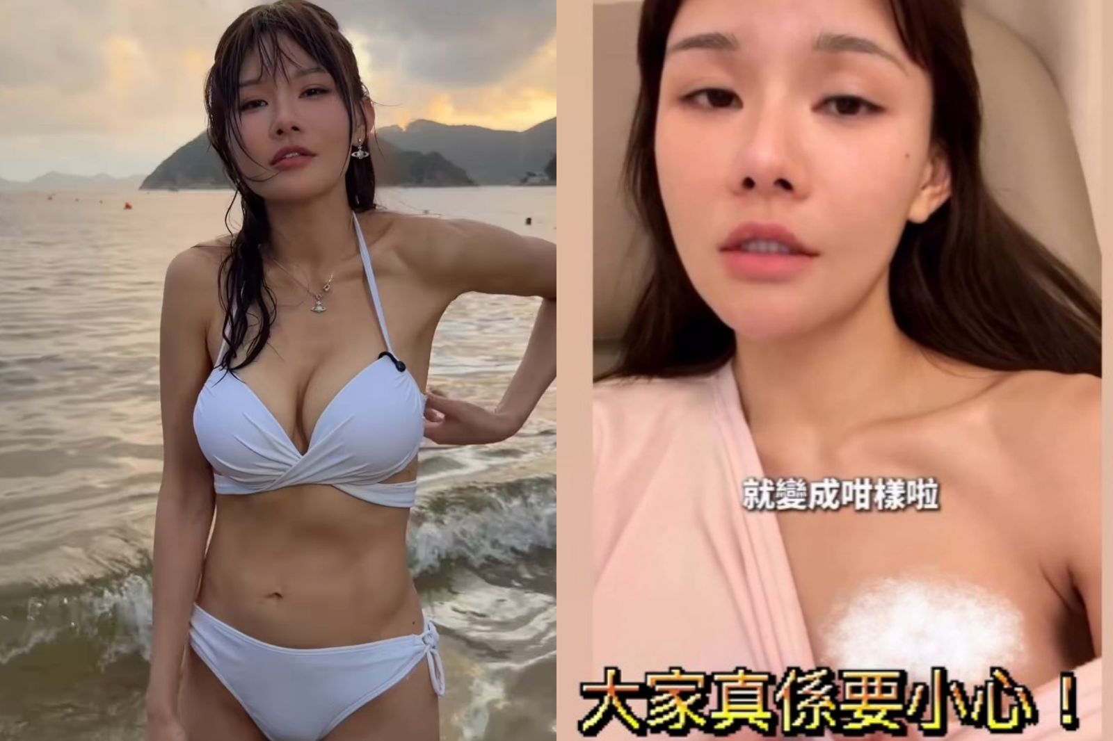 香港最強小三美乳慘遭燙傷!還原離奇受傷過程 悲喊:最值錢的地方壞了
