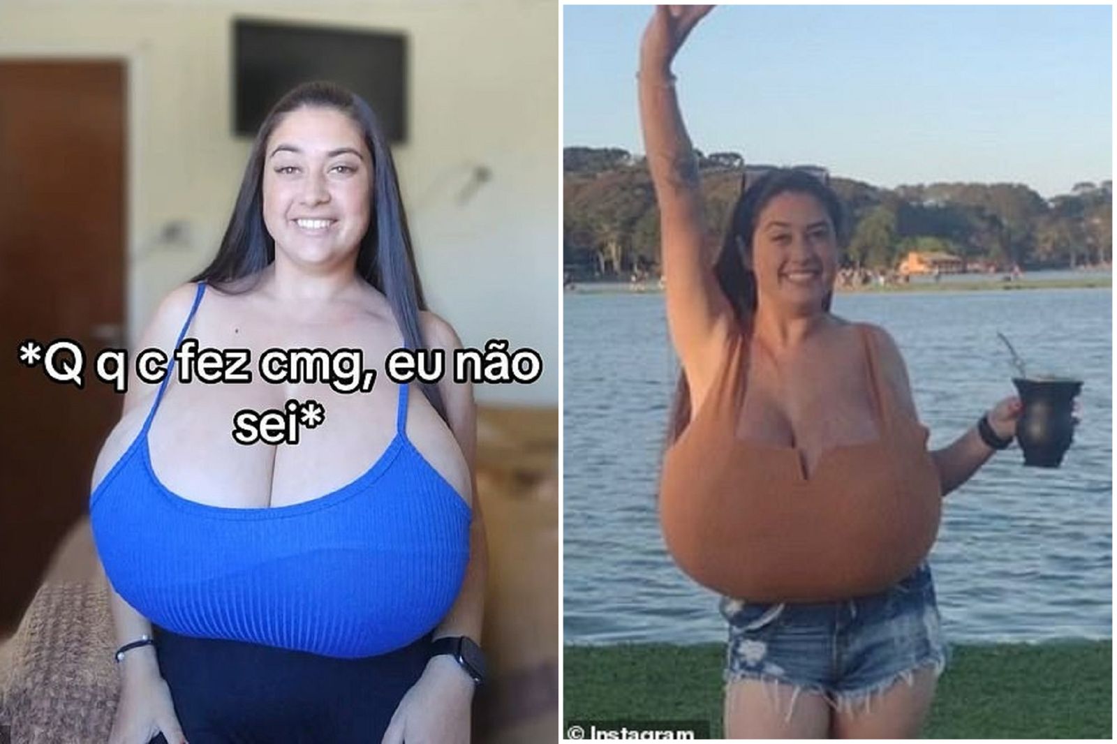 女患罕病胸部不斷長大！重12公斤如揹「2粒西瓜」　連綁鞋帶都有困難