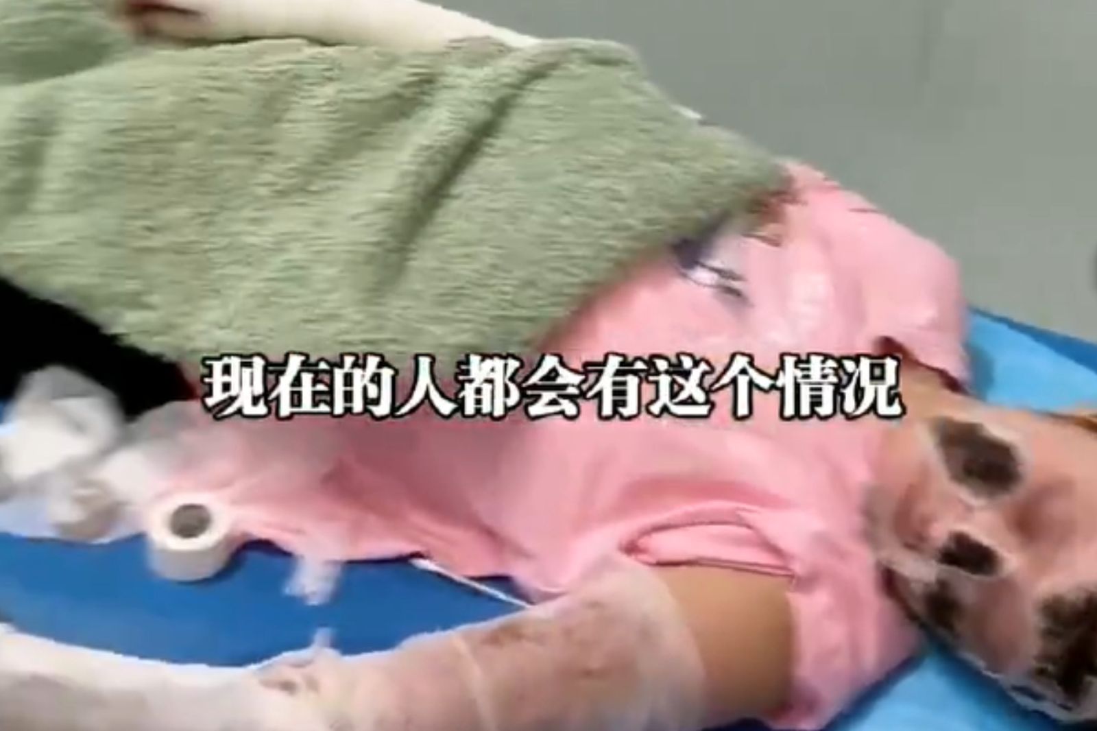 睡覺時「手機放枕頭邊充電」突爆炸!女子慘毀容、全身7成燒燙傷