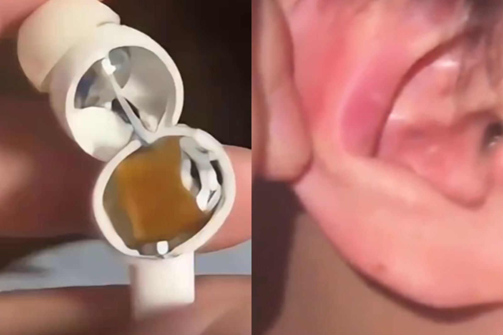男大生戴耳機睡覺突然耳機爆炸,導致耳鳴。圖/翻攝自深圳衛視微博