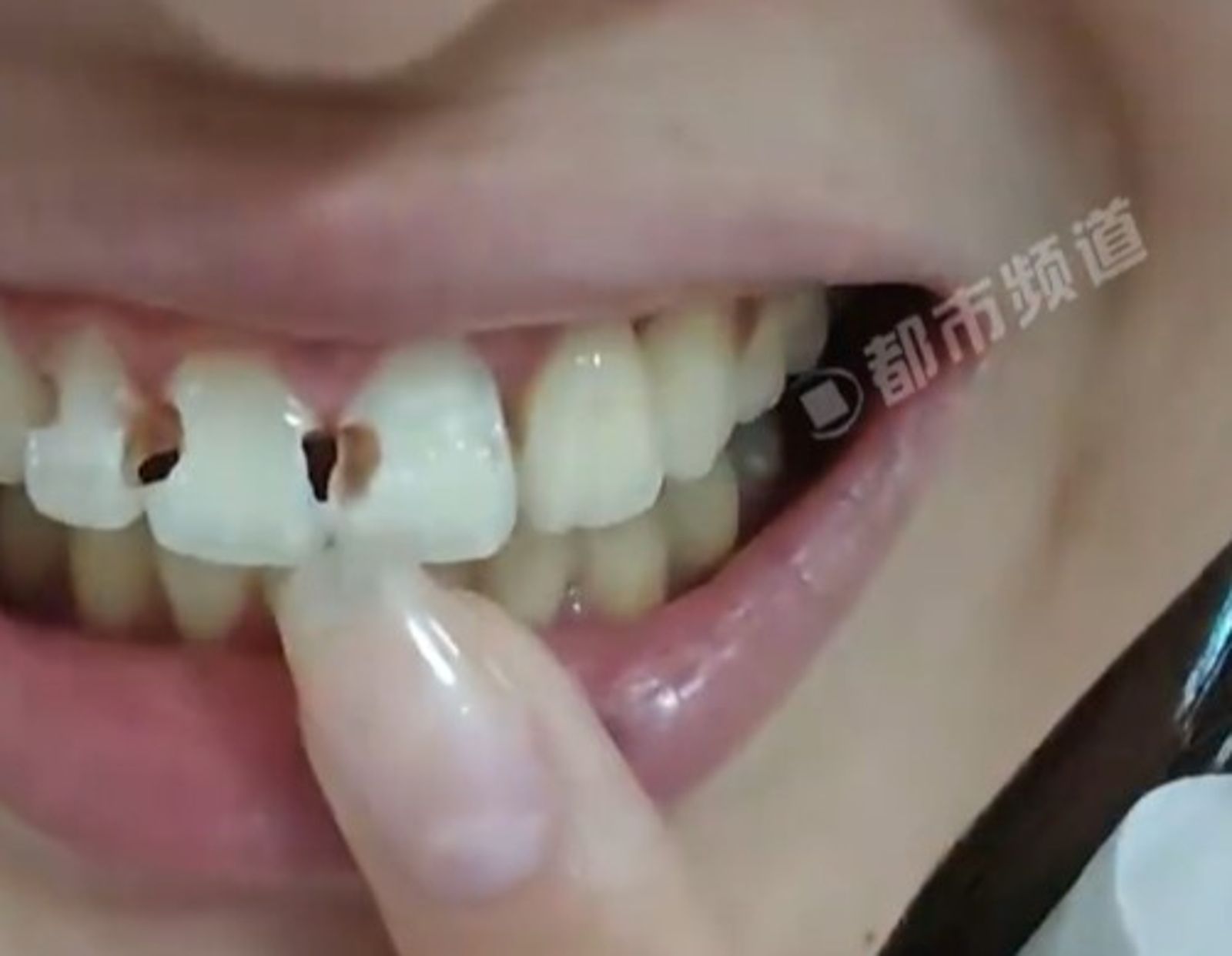 牙套戴5年…拆除驚見「8顆牙齒有洞」!醫師點名「2大致命錯誤」很多人都忽略了