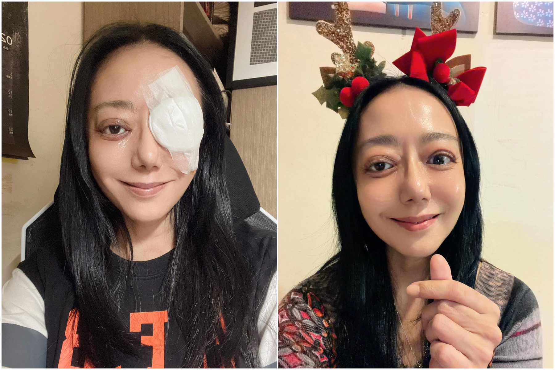 53歲高慧君連開3次刀「做好失明打算」　勇敢公開大小眼自拍照：剩最後一次