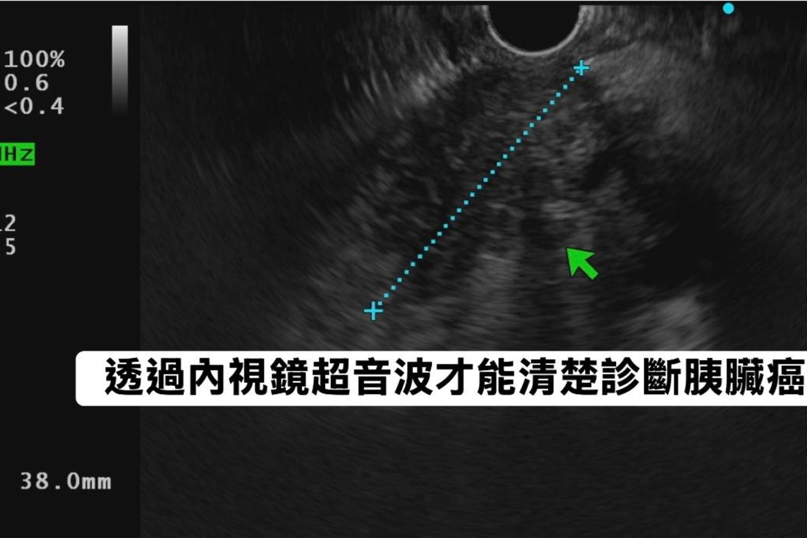 食慾差又腹漲！她半年暴瘦10公斤竟罹胰臟癌　醫籲出現「3症狀」需警覺