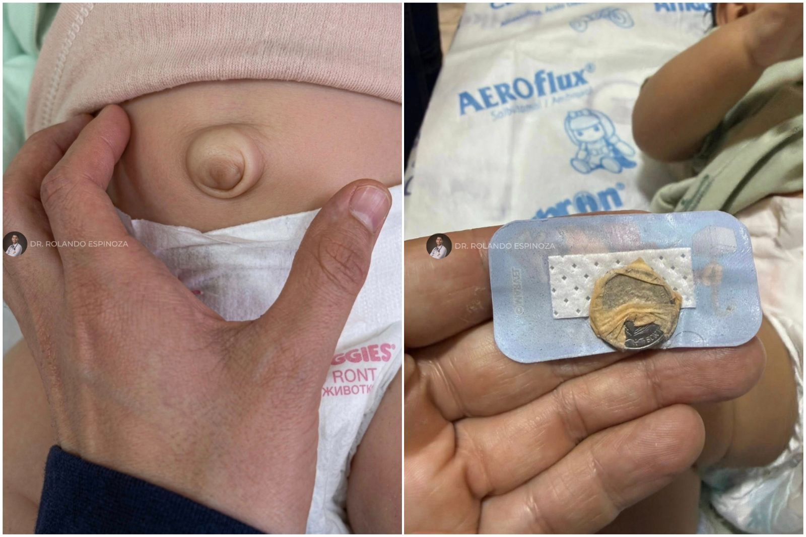 嬰兒「凸肚臍」被長輩「貼硬幣24小時」死命壓平 醫曝嚴重下場