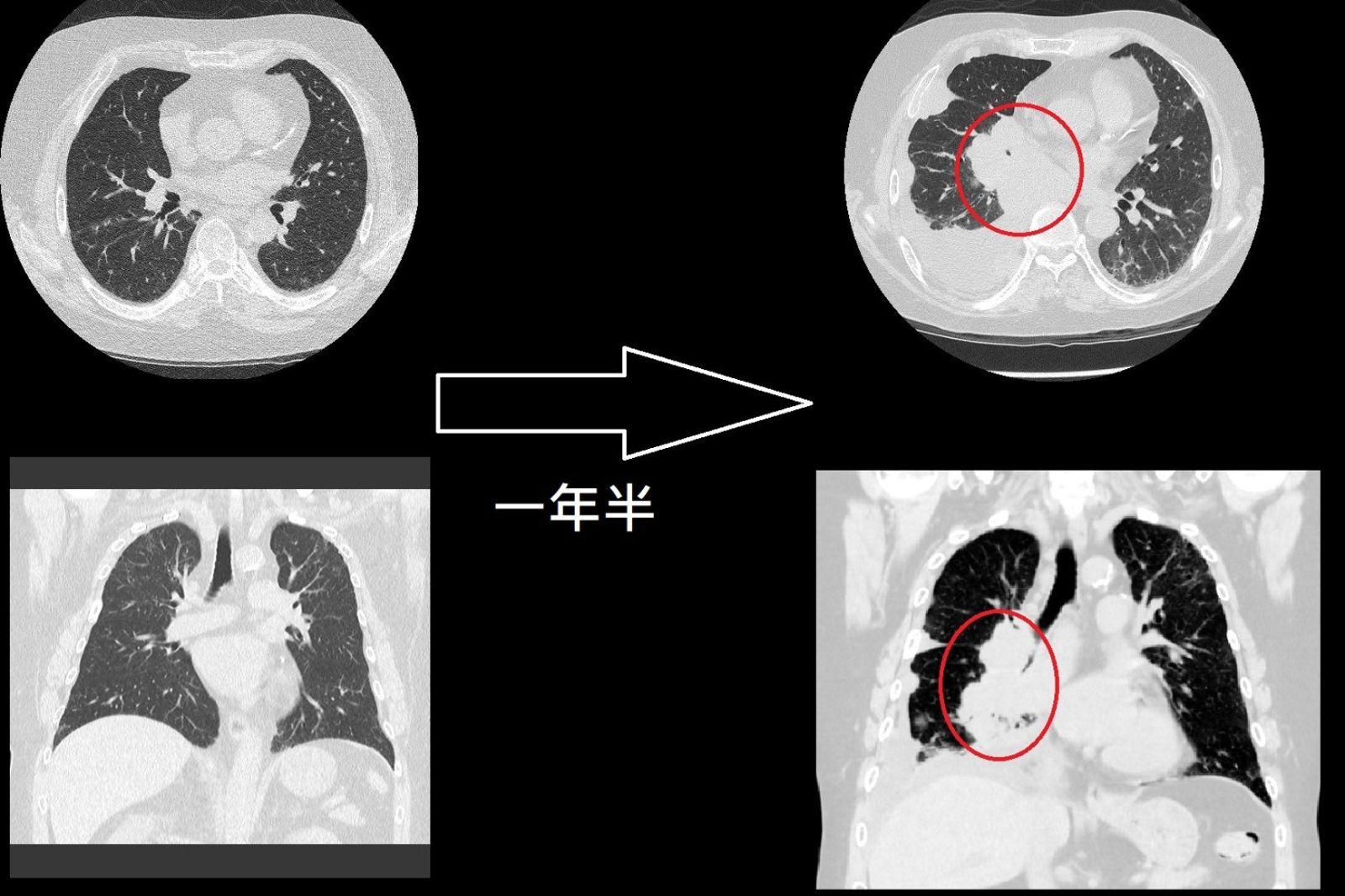 60歲男「沒有肺結節」才1年半就肺癌末期　長出巨大10公分腫瘤