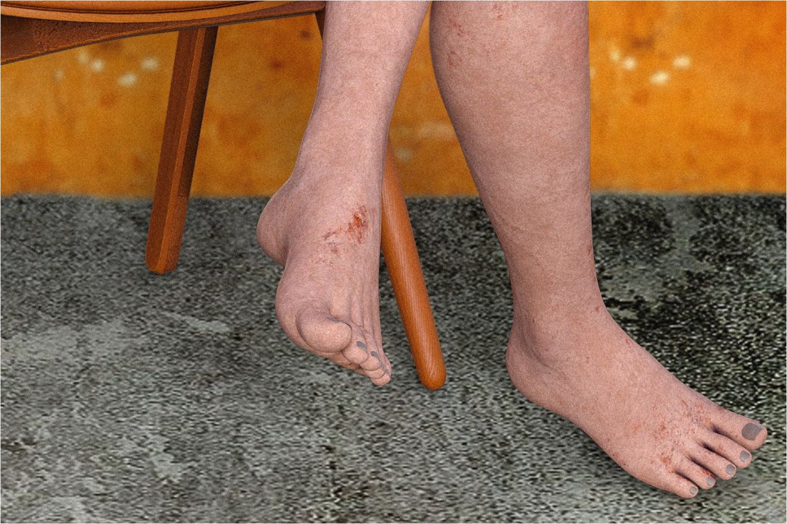 雙腳起紅疹「像紅繩一整圈纏繞」　醫曝恐怖排列：牠邊走邊咬