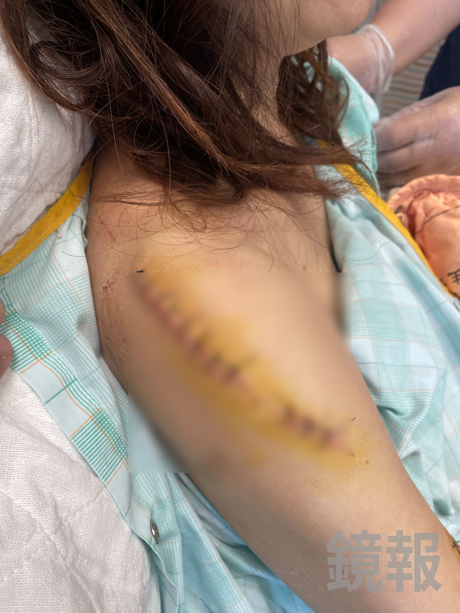被害人雙手都是手術縫合的痕跡，讓家屬很捨不得。