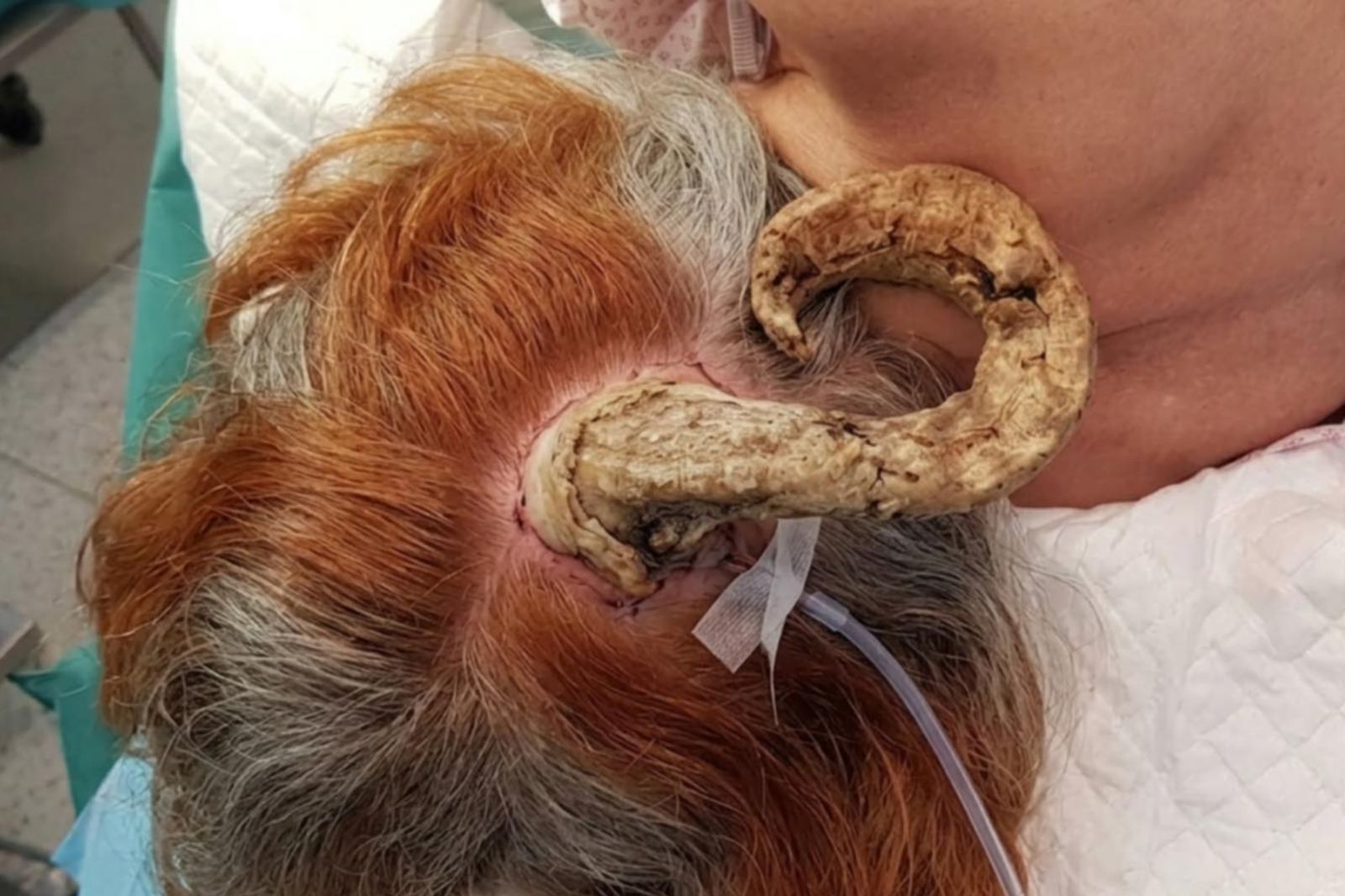 75歲嬤後腦長出「26cm惡魔角」!一檢查竟罹皮膚癌 驚悚畫面曝光