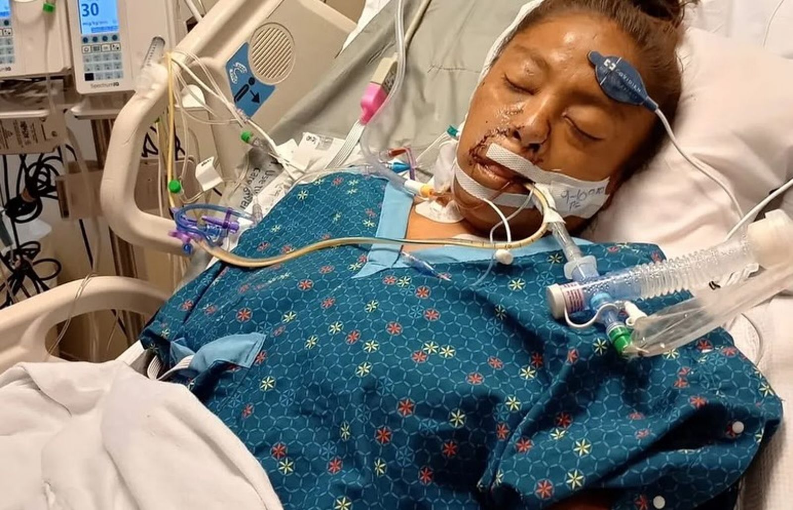 超慘!騎自行車「突遭比特犬攻擊」 女子重傷「四肢被截」