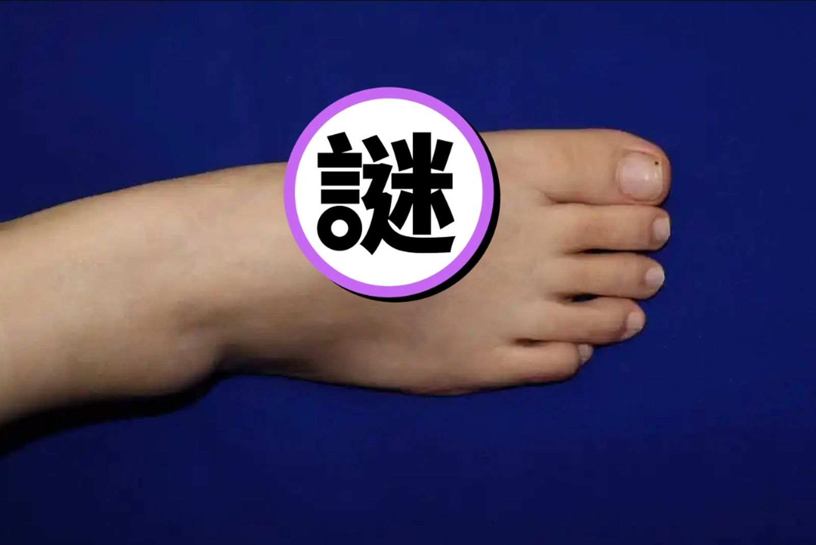 太神奇！她「左耳被扯斷」　醫生把它「寄養在腳背上」：5個月後恢復了