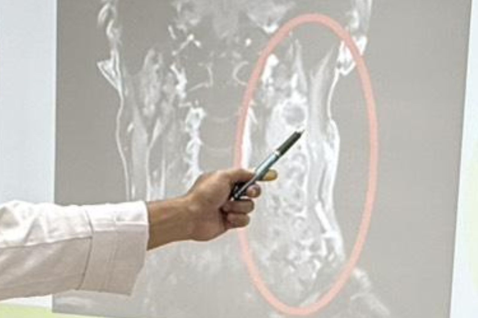 台中養生男「脖子微腫」以為小事！MRI一照竟是12cm巨獸卡頸...醫也找無源頭
