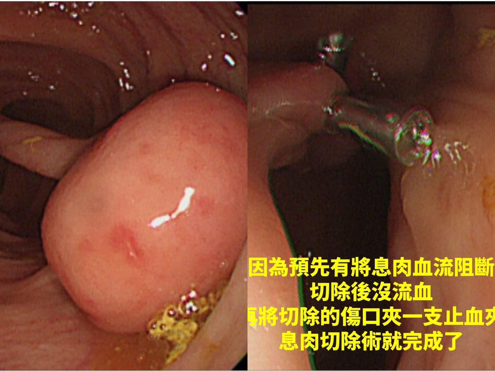 驚悚！男腸道驚見「雷神之鎚」	醫5分鐘切除「巨型息肉」解除大腸癌危機