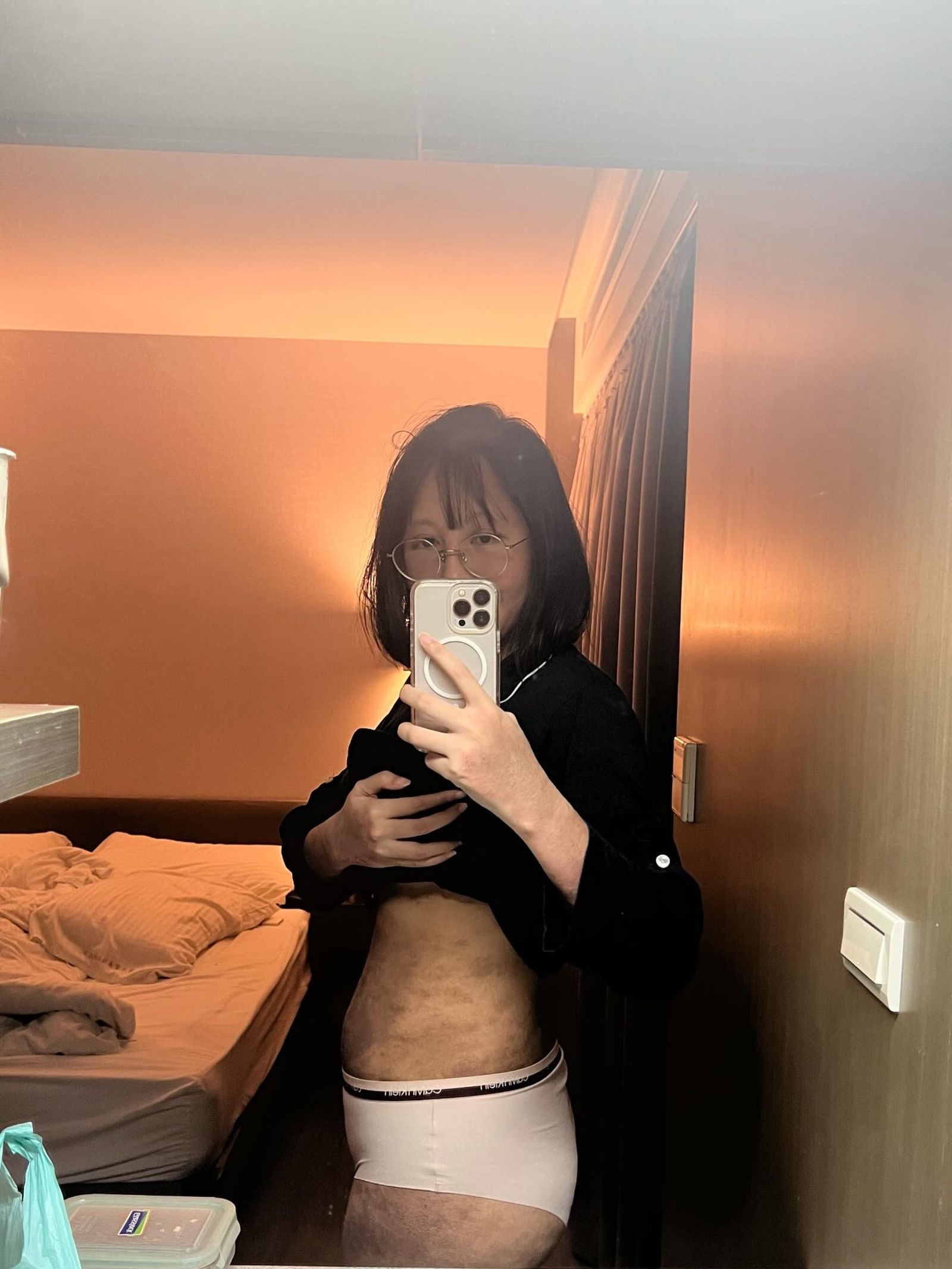 織織曝光自己異膚炎的照片。翻攝threads@chichinote