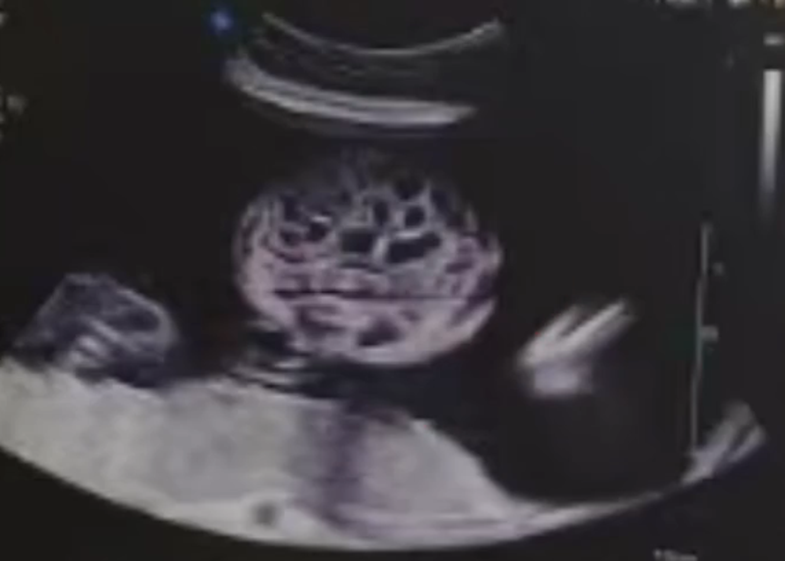 寶寶還沒出生就在「拉肚子」竟是罕病!醫曝1基因出問題:機率僅10萬分之1
