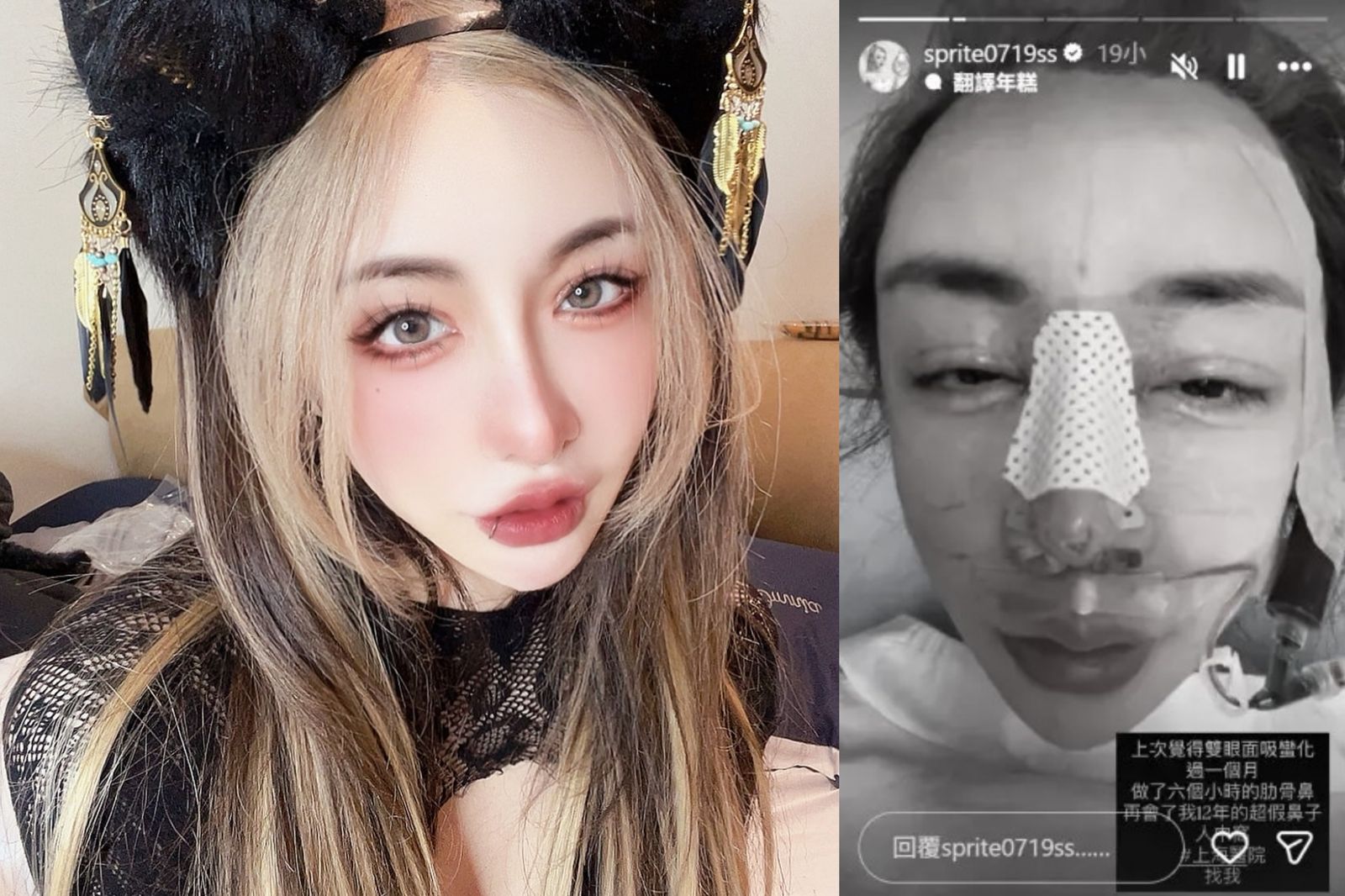 砸千萬整形！雪碧上海「插管引流」驚悚照曝　認了「告別12年超假鼻」