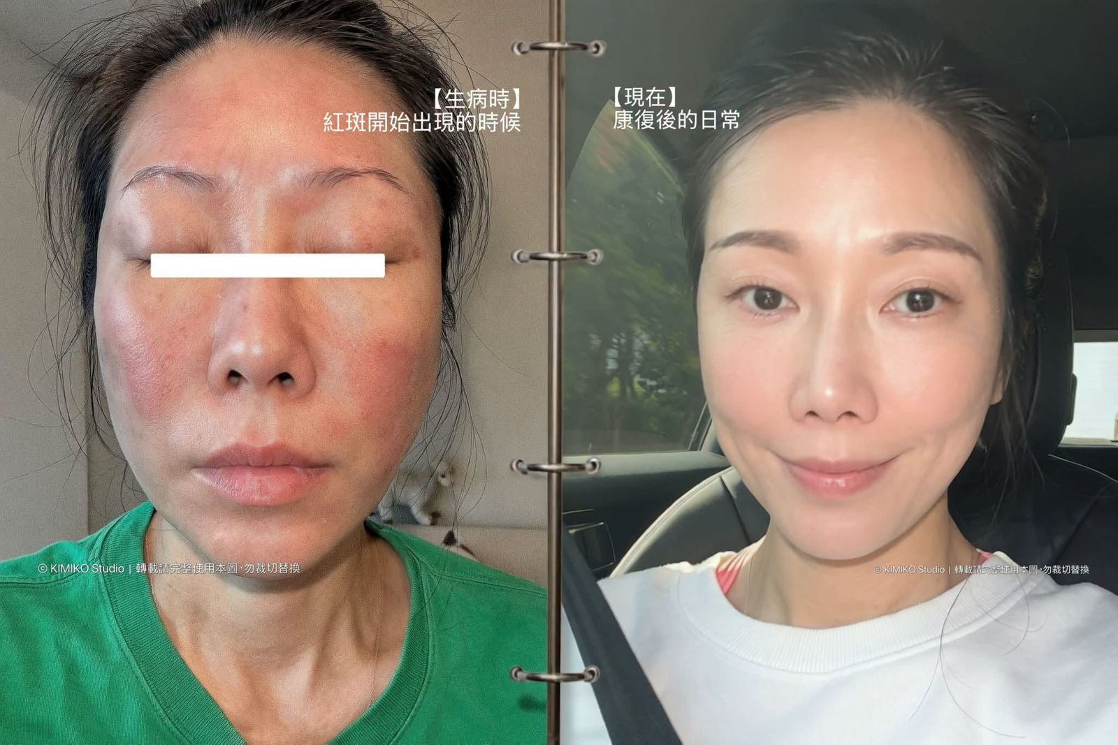 KIMIKO先前嚴重過敏。翻攝KIMIKO臉書
