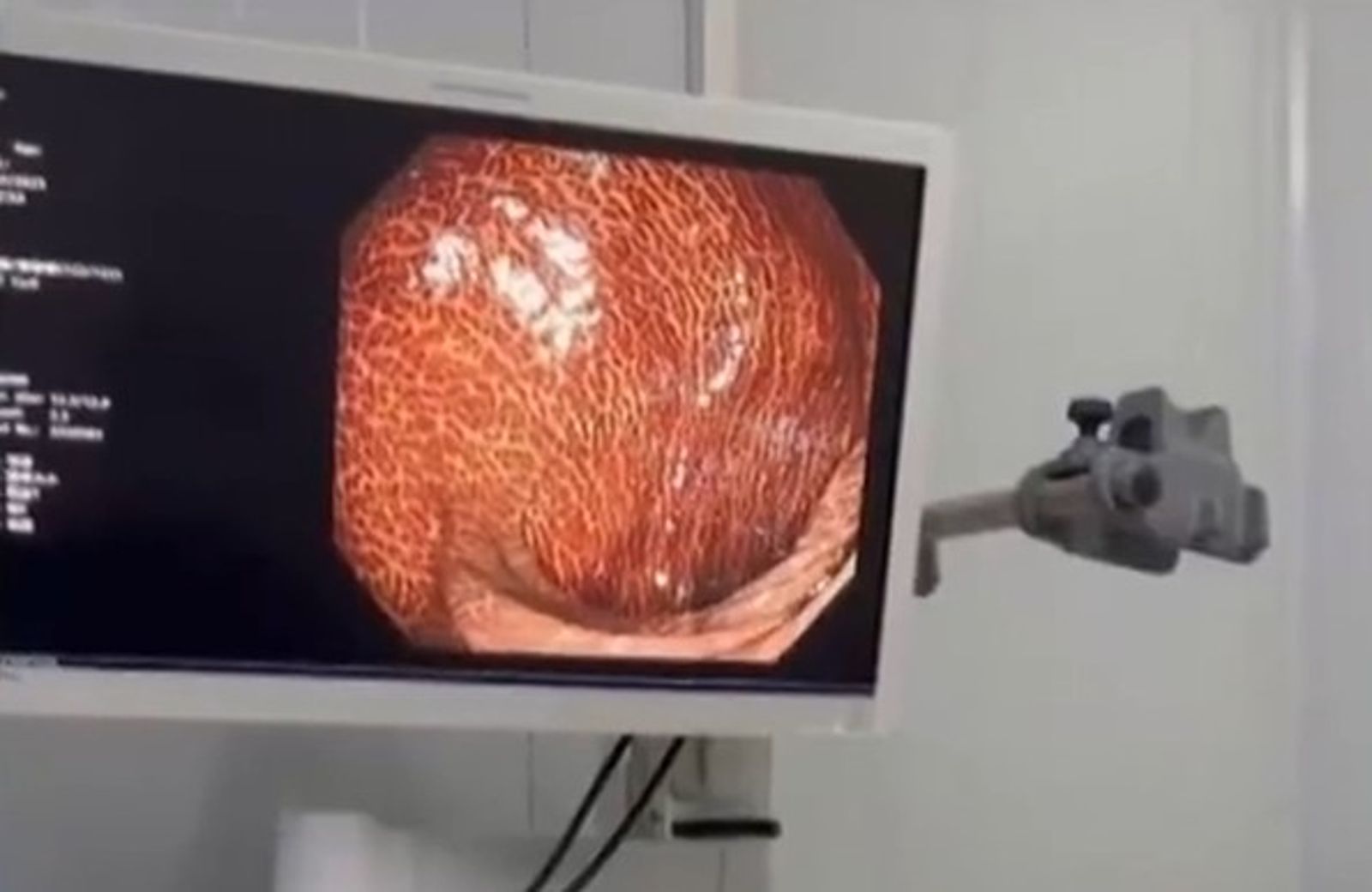 便秘人小心！她長期吃瀉藥「腸道變豹紋」還切30公分保命…醫示警：恐增癌變風險