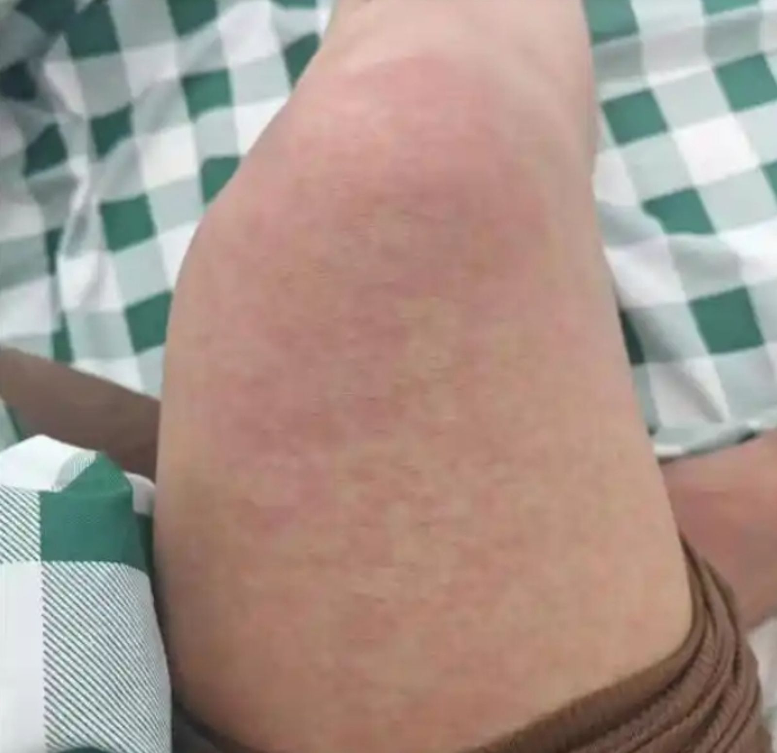 潘姓男子全身起疹子。圖/翻攝瀟湘晨報