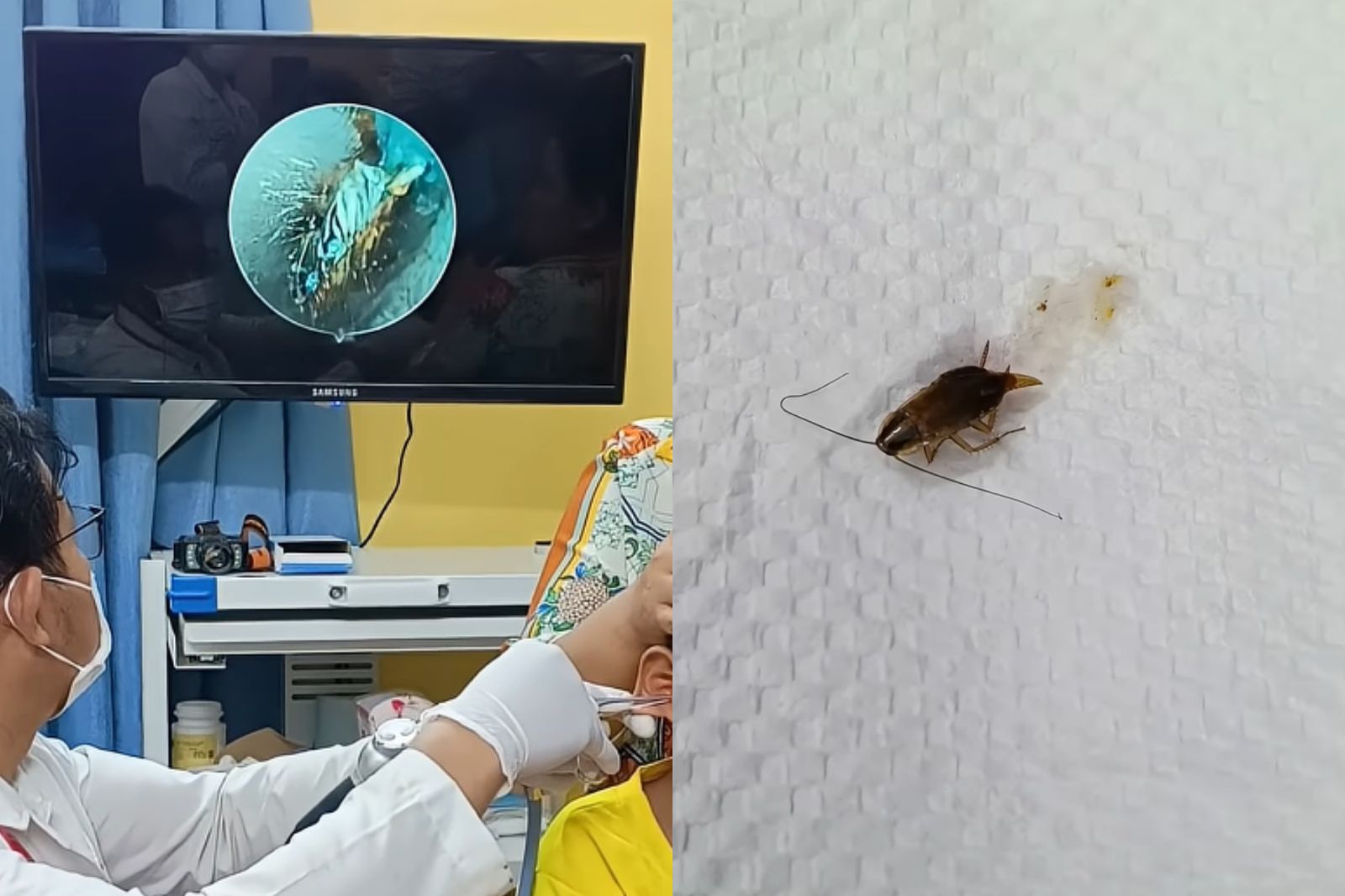 男童耳道藏一隻活蟑螂。圖/翻攝自YT@The Daily Dose