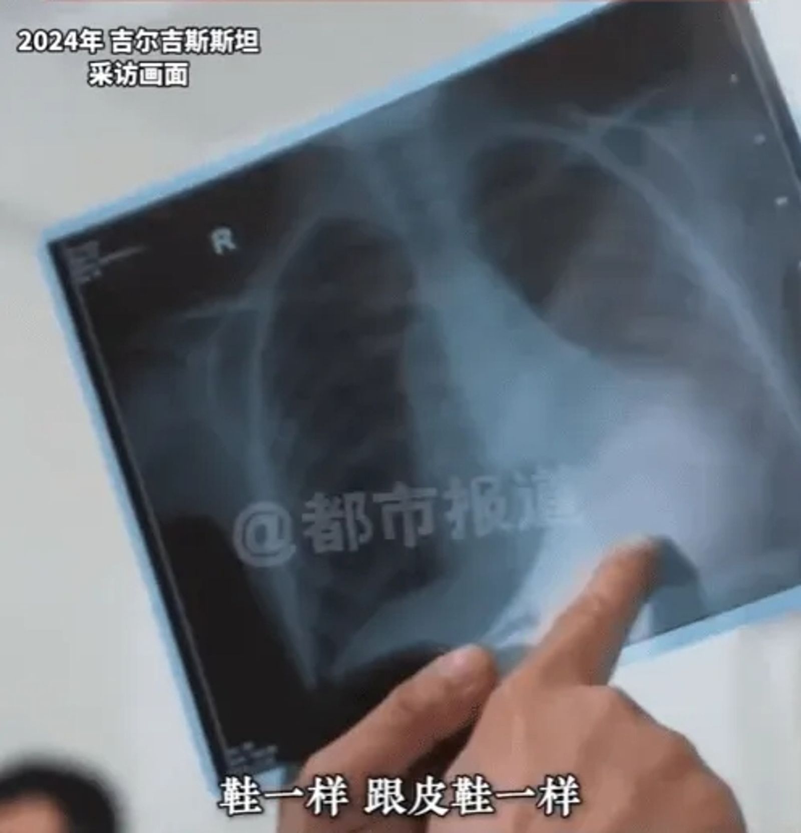 少年的心臟變形如鞋子一樣。圖／翻設都市報導