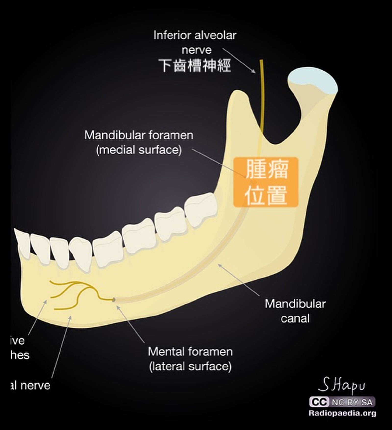 一名女病患長期牙痛,檢查後竟「罹患乳癌」。圖/翻攝自張家豪臉書