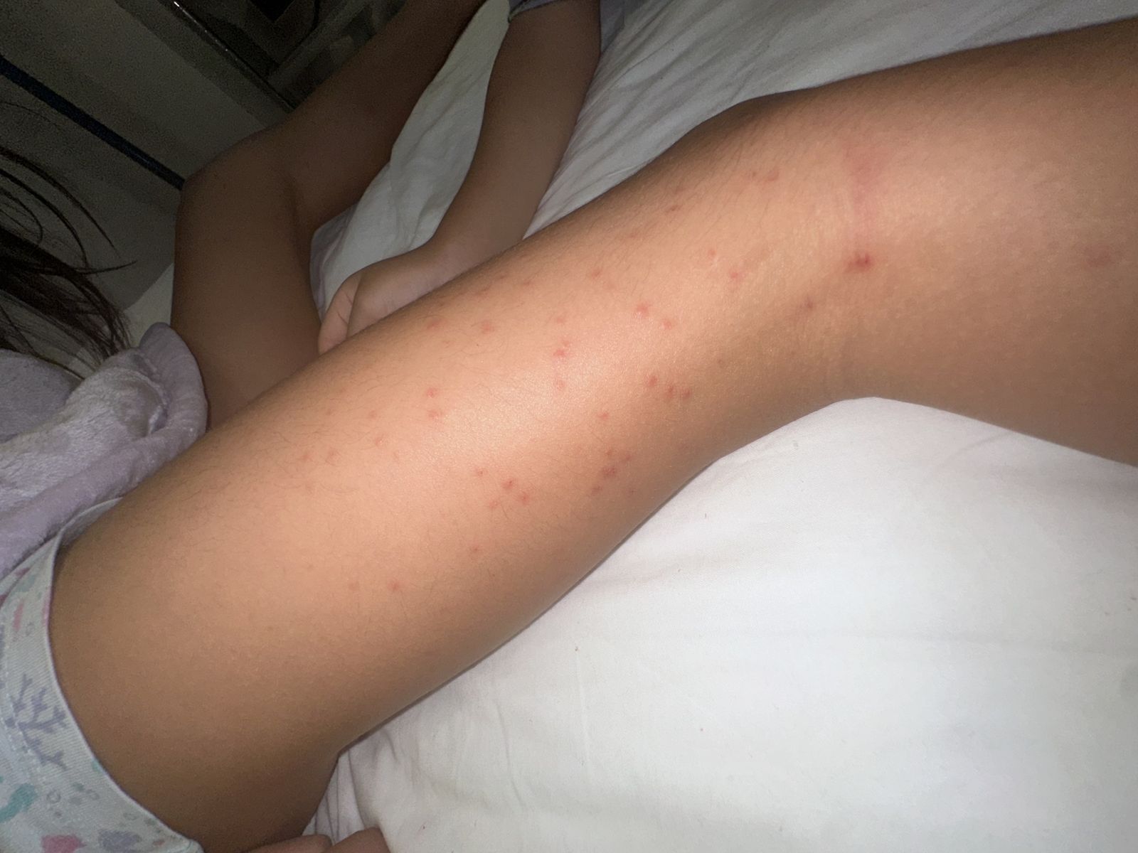 住客拍下四肢被蟲咬的照片。圖／好想住飯店⭕好康.踩雷不藏私  FB