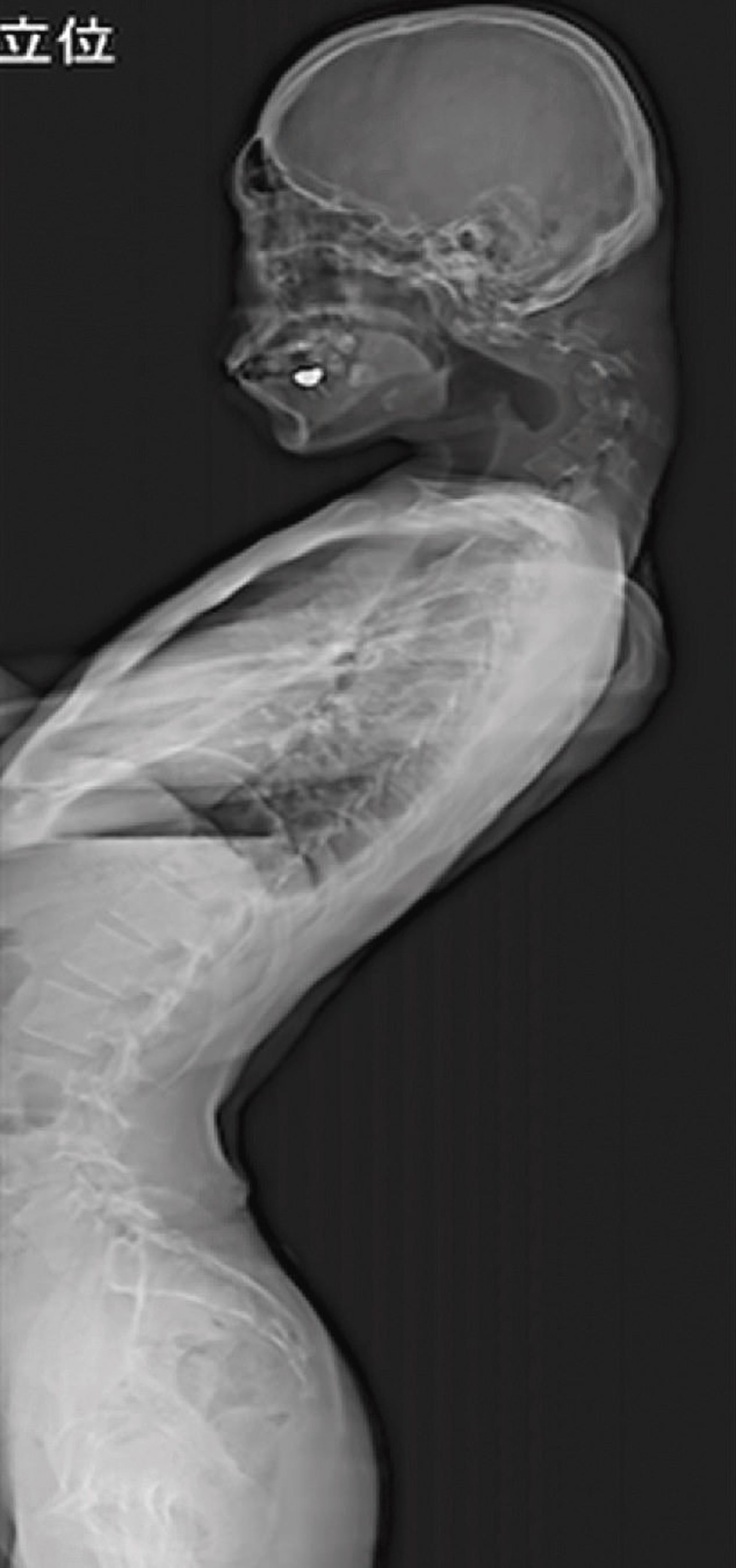 男子長期間低頭玩手遊，頸椎嚴重變形。圖／翻自《JOS病例報告》