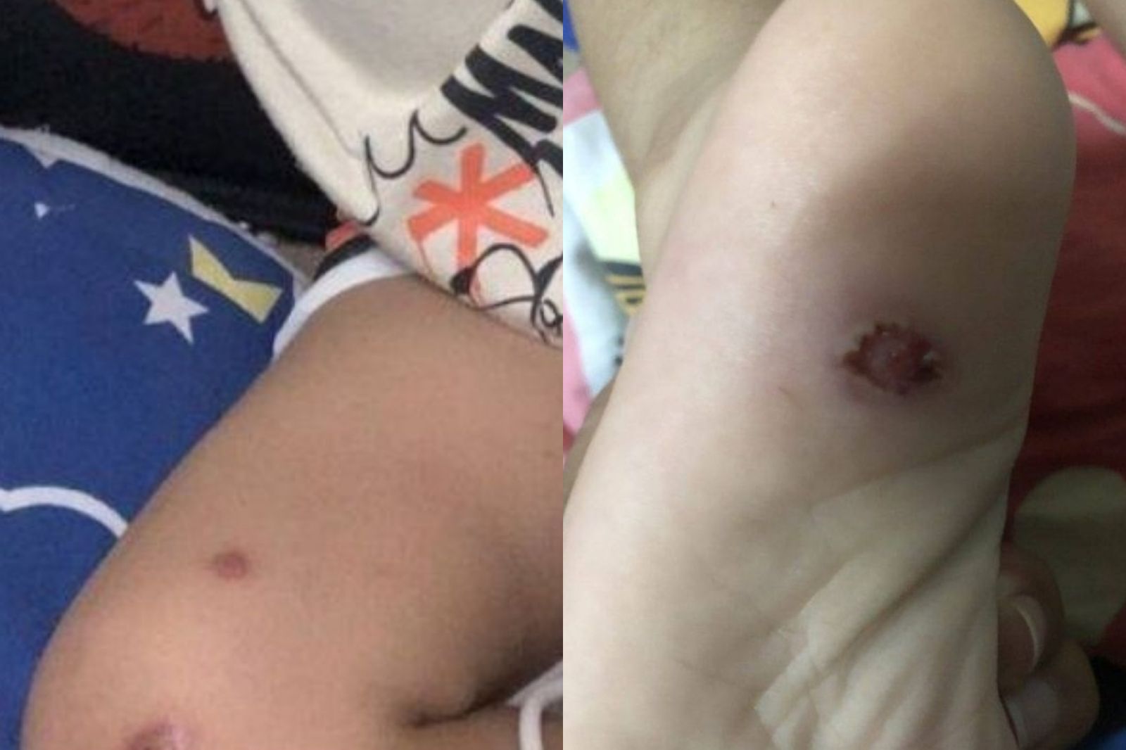 3歲男童遭「菸頭燙下體」慘死!20歲繼父被捕認了:沒想到他會死