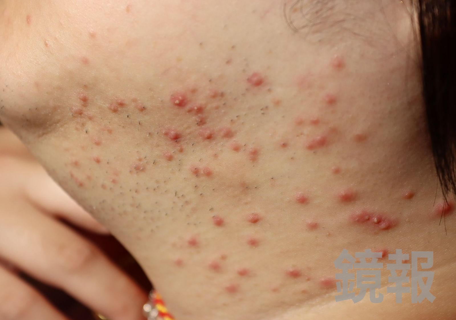 女子原本白皙的胸口與頸部,滿是紅腫膿皰。台中茂盛醫院提供
