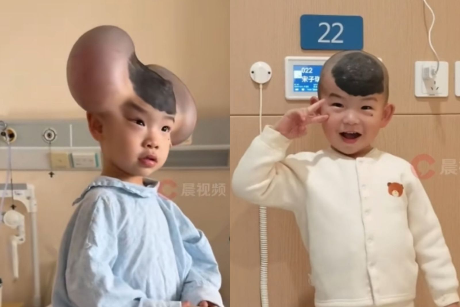 3歲童頭長巨痣「被笑像米奇」！手術成功笑開懷　媽媽感動：擦乾眼淚往前走