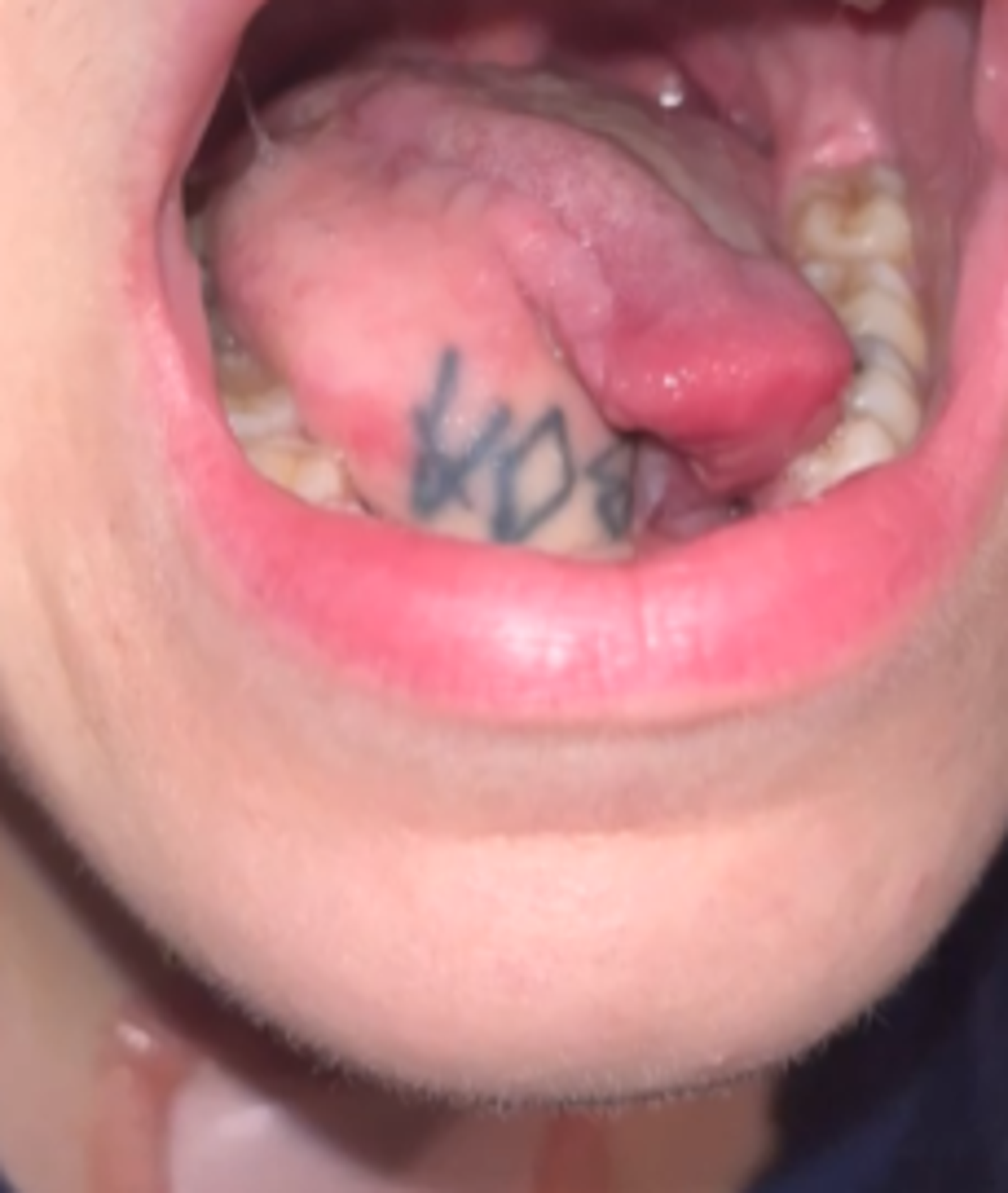 醫師將Hazel舌頭部分區域切除、除去腫瘤。圖／翻攝自X