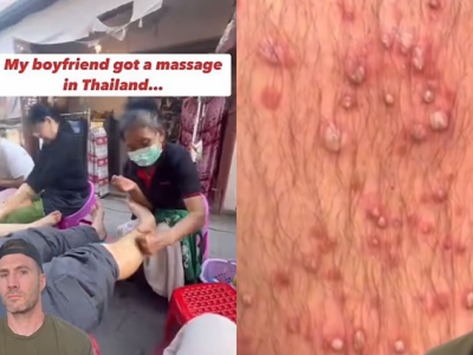 醫師認為男子可能感染金黃色葡萄球菌。圖/翻攝自IG@Dr Joe Whittington