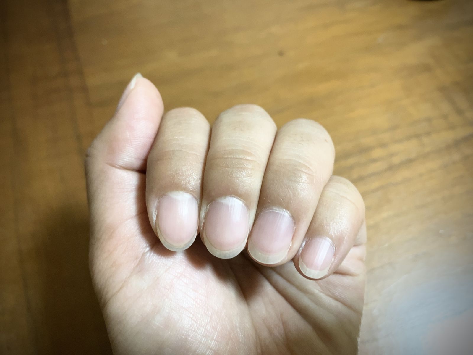 指甲變鼓像棒棒糖?名醫警告恐罹患重大疾病。圖/PhotoAC