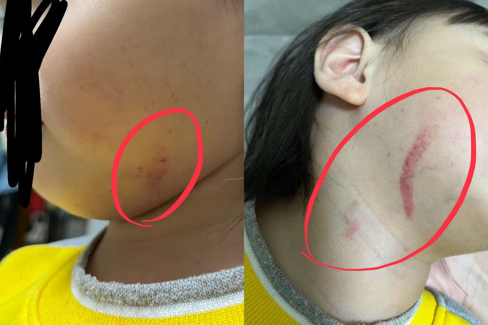 新莊某幼兒園疑虐童!孩子「脖子瘀血、手腕脫臼」 園方:不清楚受傷原因