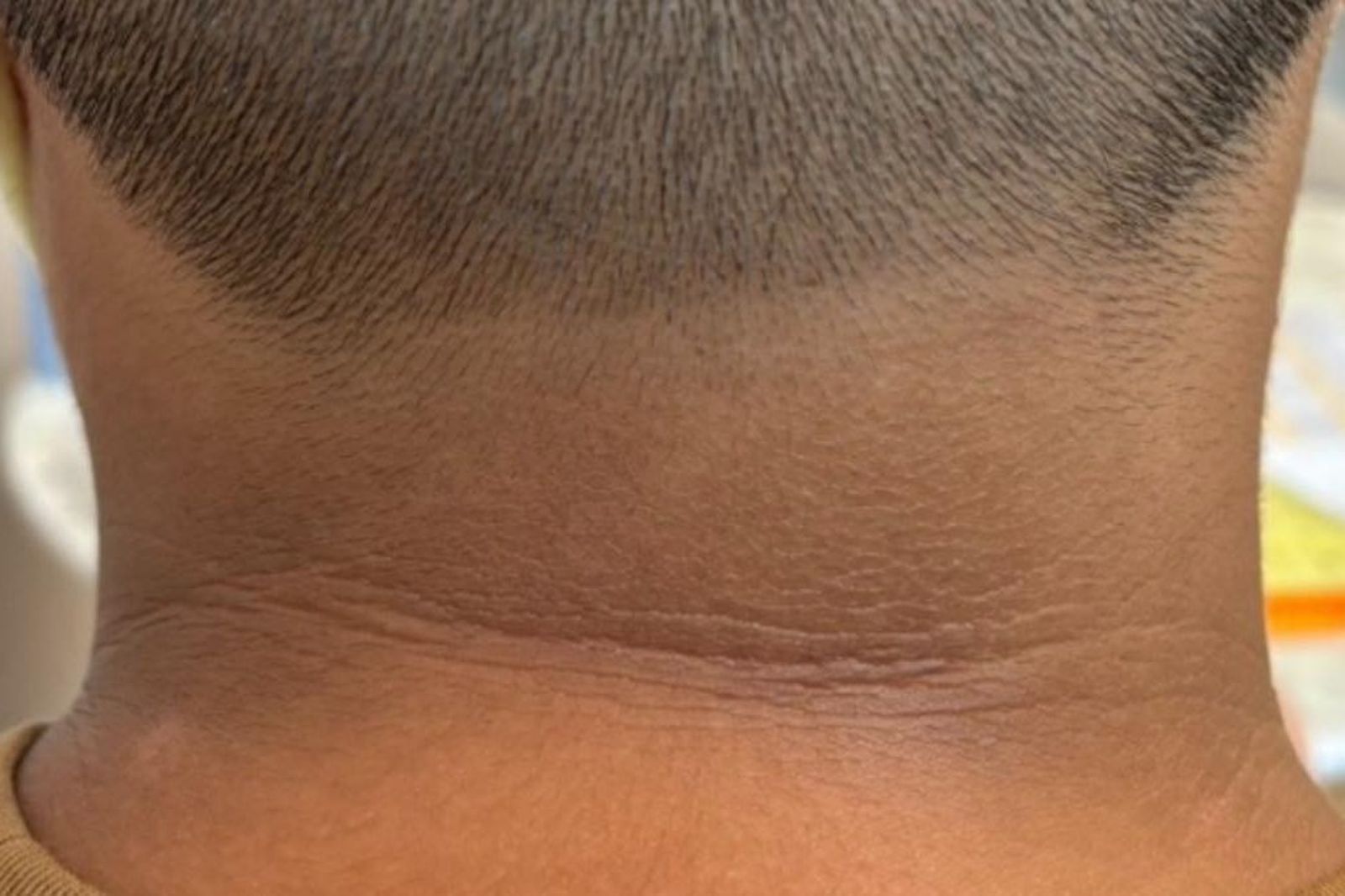 小學生脖子黑一圈變粗糙!醫師警告:恐是糖尿病前兆