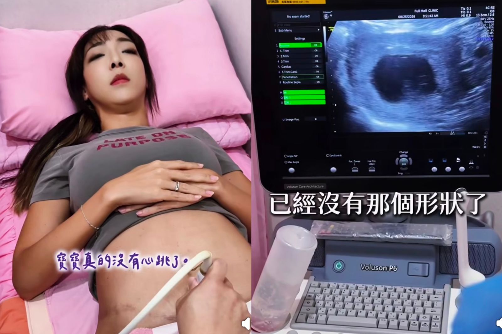42歲李宓痛失第6胎!7週還聽見心跳「8週突停止」 超音波照寫最後一封信