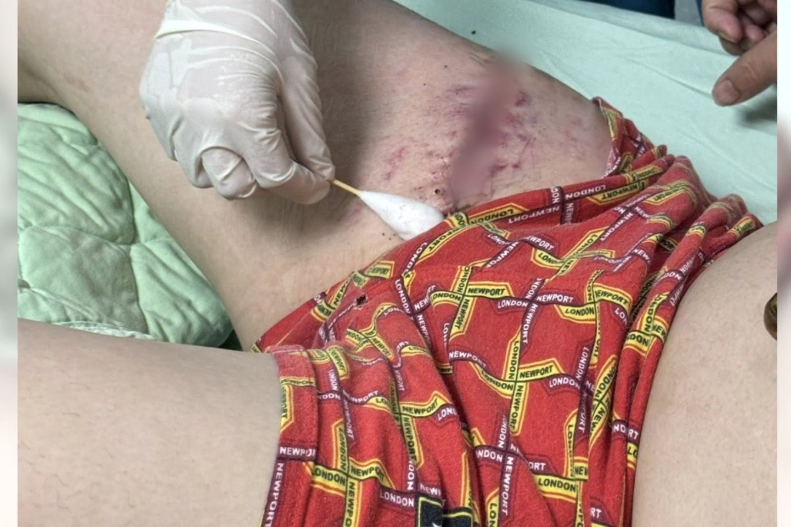 國道休息站爆「隨機砍人」驚悚傷口照曝光…肌腱都斷了