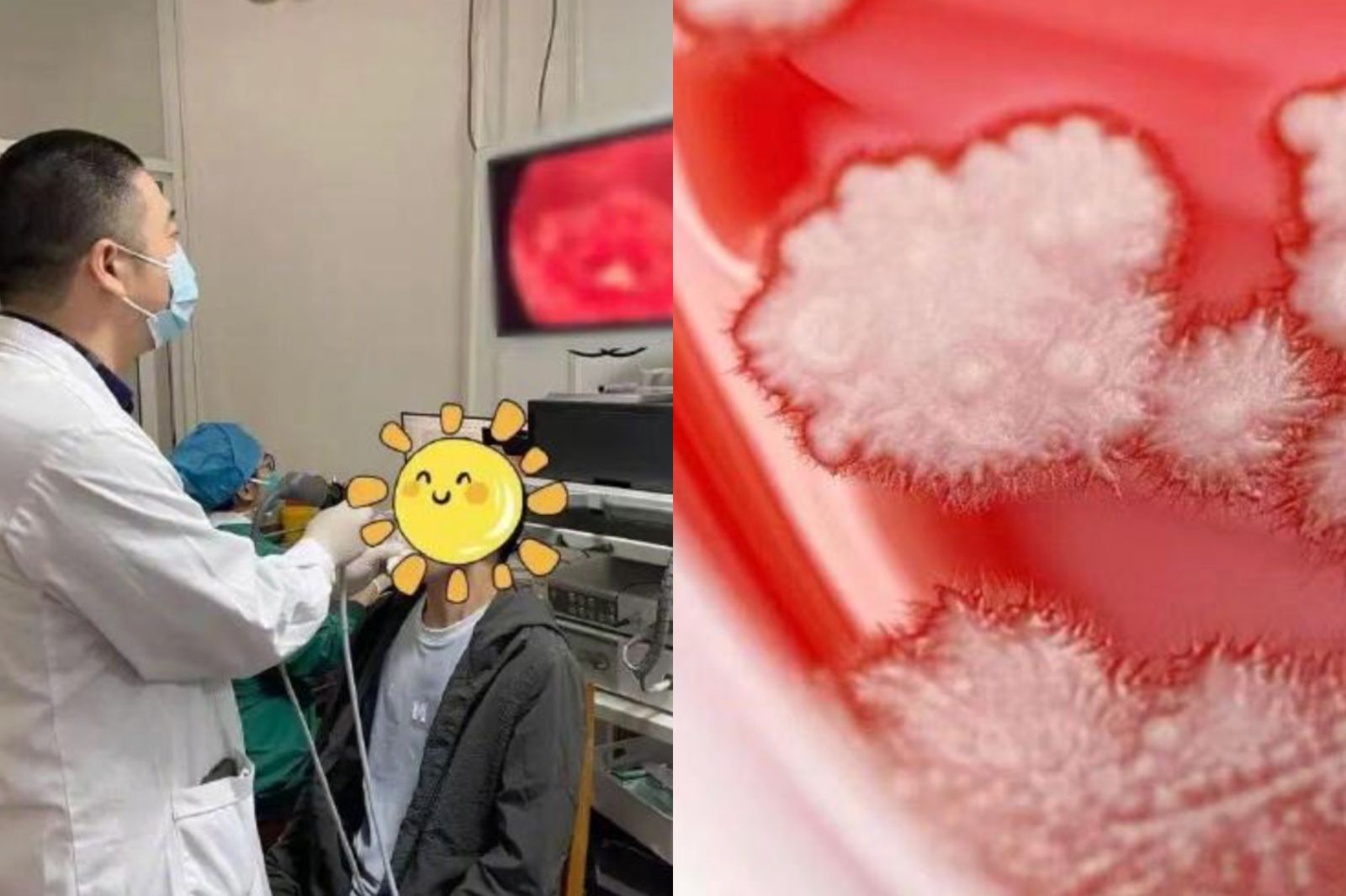 36歲男感冒狂吞抗生素　喉嚨「長出一排雪花」慘罹1疾病。圖／翻攝自微博