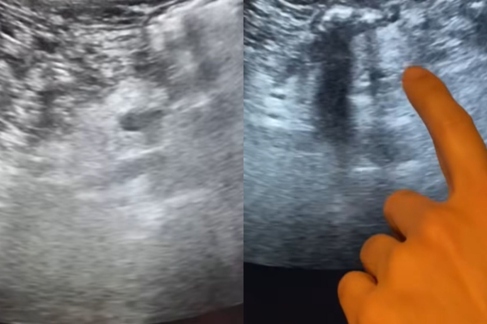 癌王有前兆！罹「1疾病」胰臟癌風險增60%　醫：6族群要小心