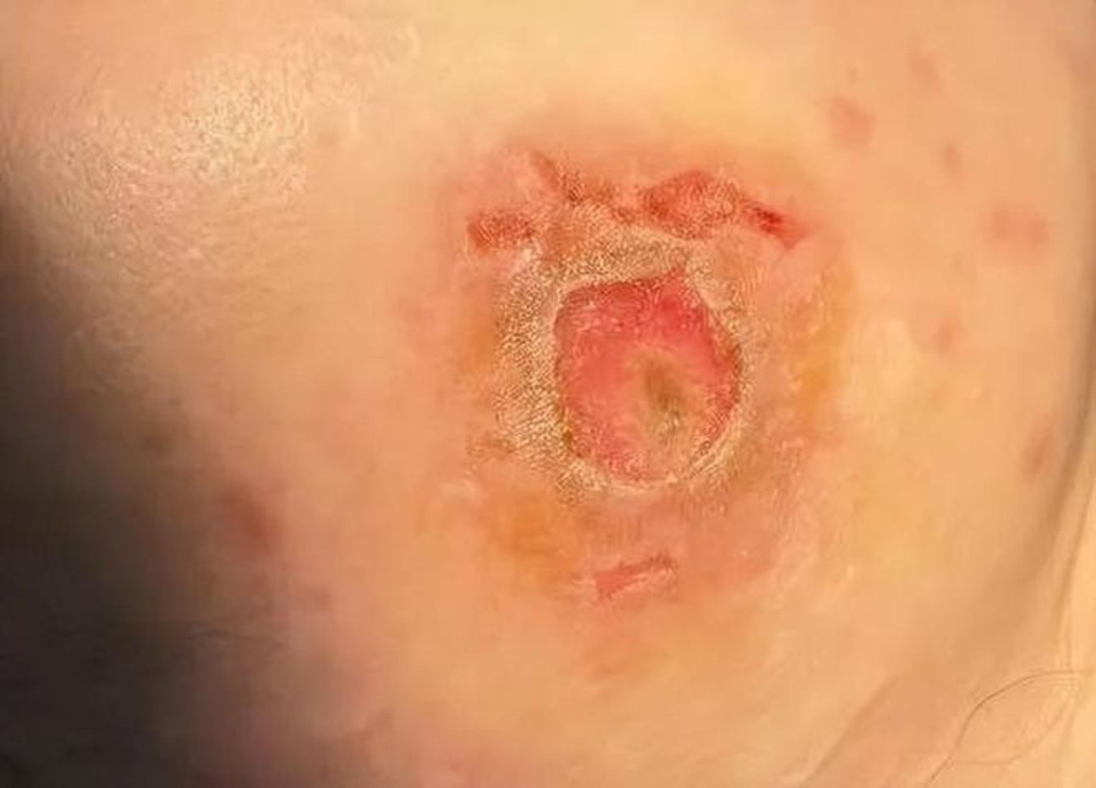 以為只是痘痘!她亂擦藥2個月「臉爛出巨坑」流膿飄臭味…醫揭驚悚真相:恐顱內感染