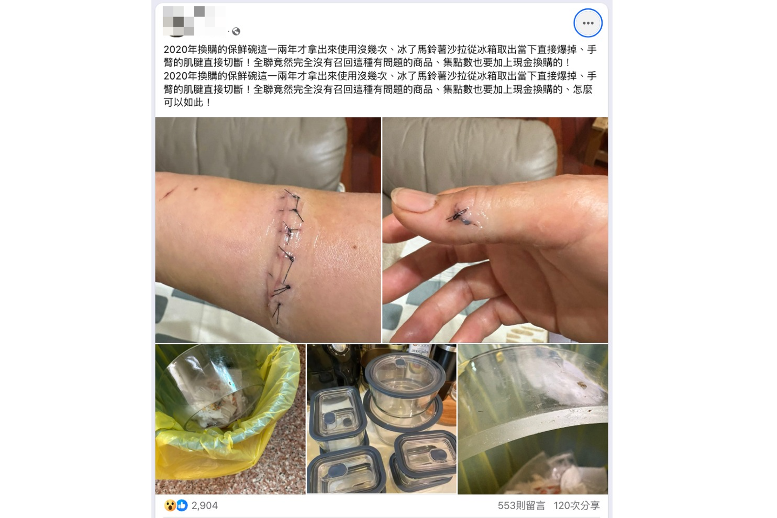 一名消費者換購全聯的保鮮盒,竟突然爆裂「割斷手臂肌腱」。圖/翻攝自全聯消費老實說 臉書社團