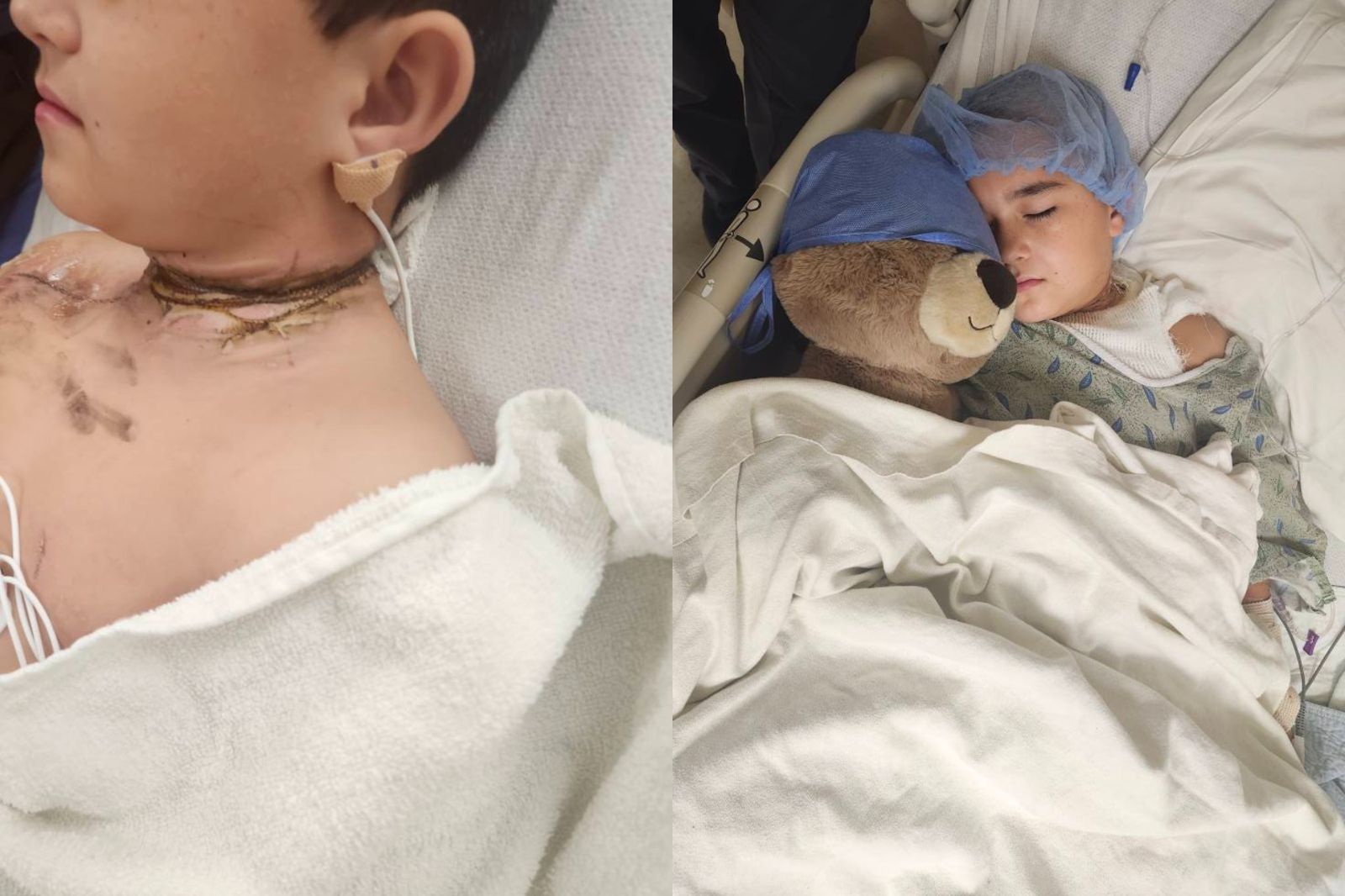 睡覺翻身項鍊卡插座！8歲童觸電「脖子燒黑一圈」　緊急1舉動成功自救