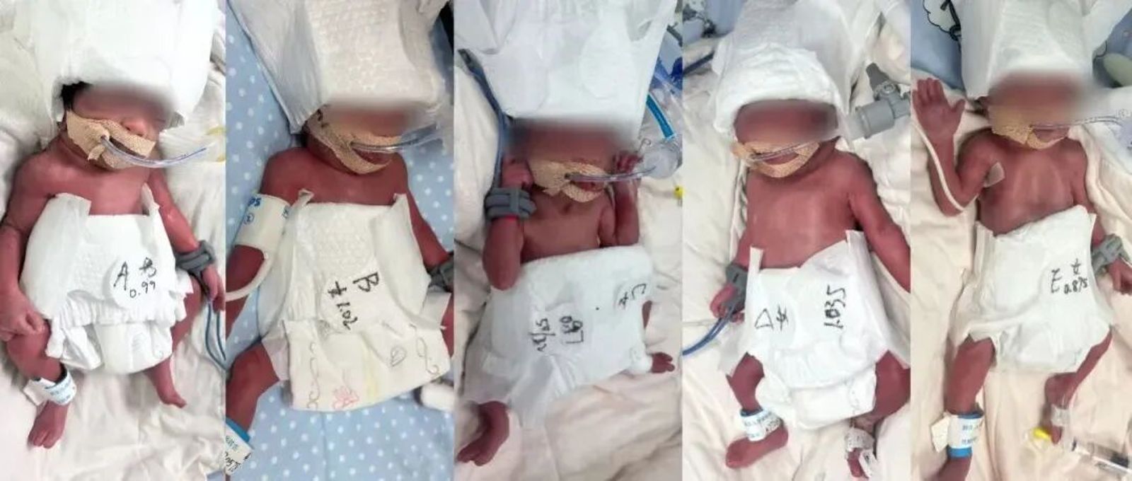 5胞胎生命徵象穩定。圖／翻攝自《南方網》
