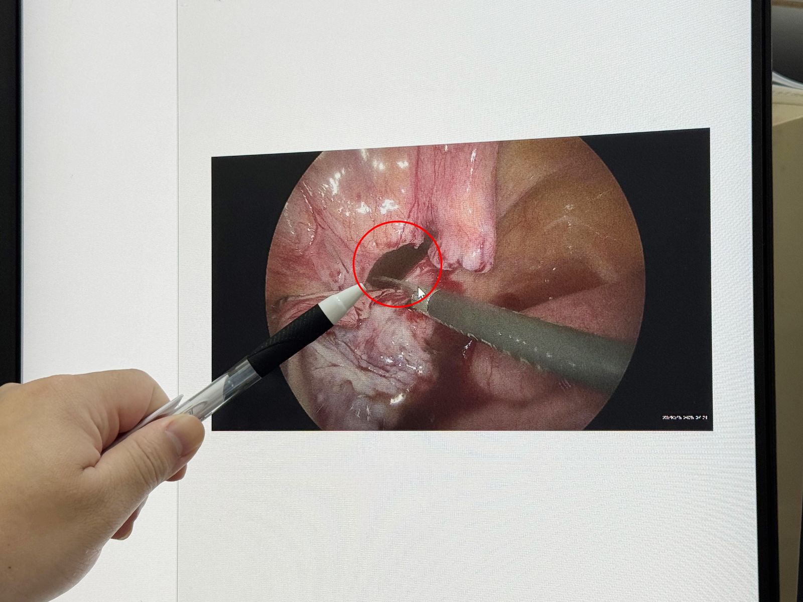 男子膀胱有一個3x3公分的裂縫。圖／李綜合醫院提供