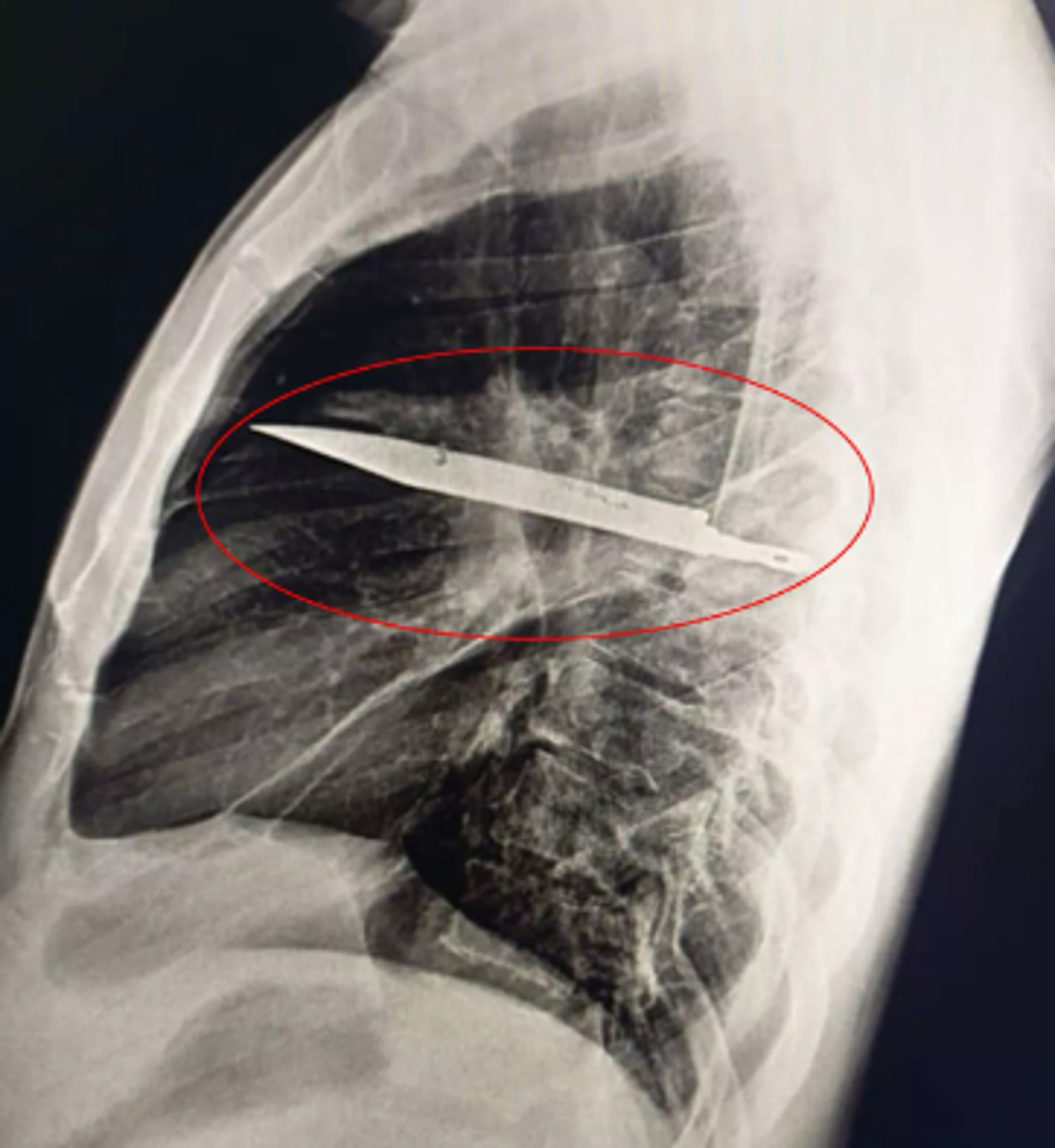 照X光才發現胸腔內卡刀片。圖／翻攝自Journal of Surgical Case Reports