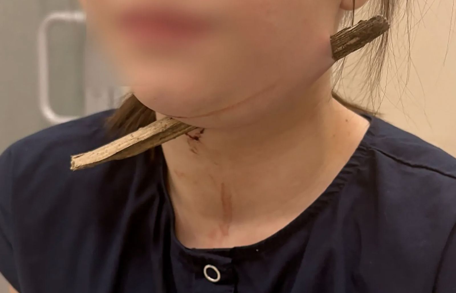 女學生墜落遭樹枝「貫穿脖子」!木刺穿頸而出 醫揭奇蹟生還關鍵
