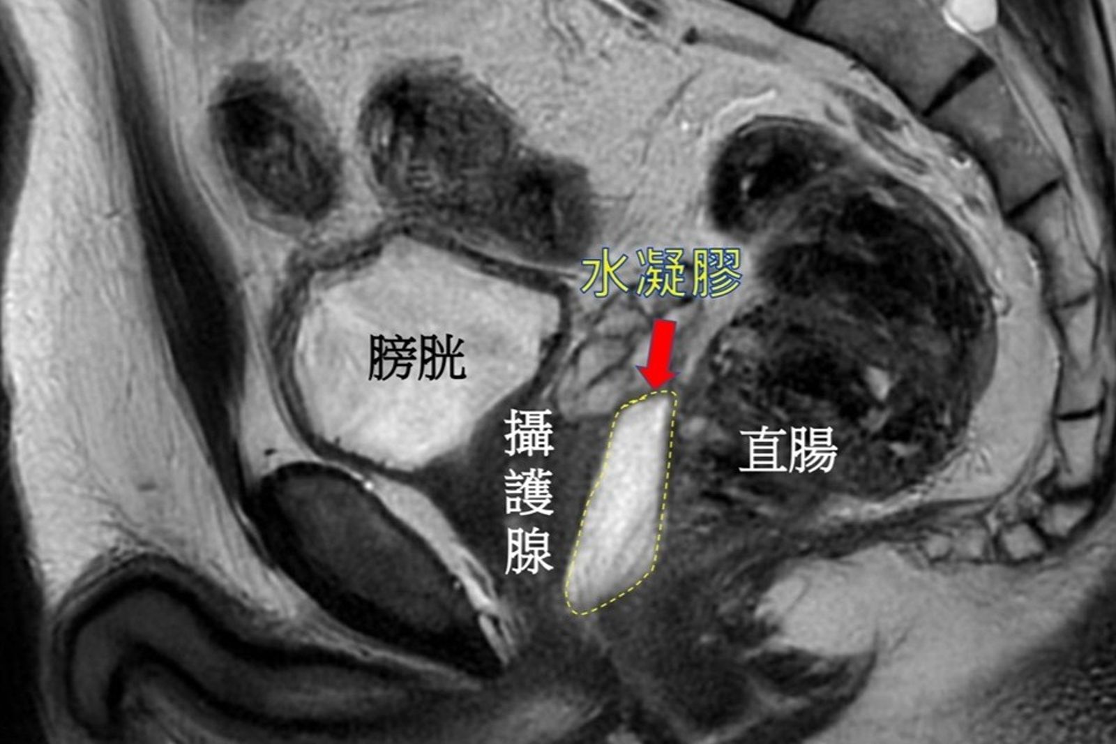 水凝膠於MRI影像中的位置示意圖。（亞東醫院供圖）